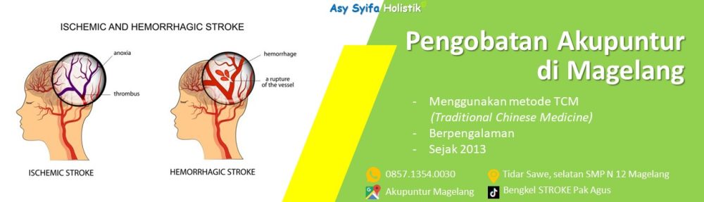 PENGOBATAN STROKE & NYERI PAK AGUS MAGELANG – WA: 0857.1354.0030