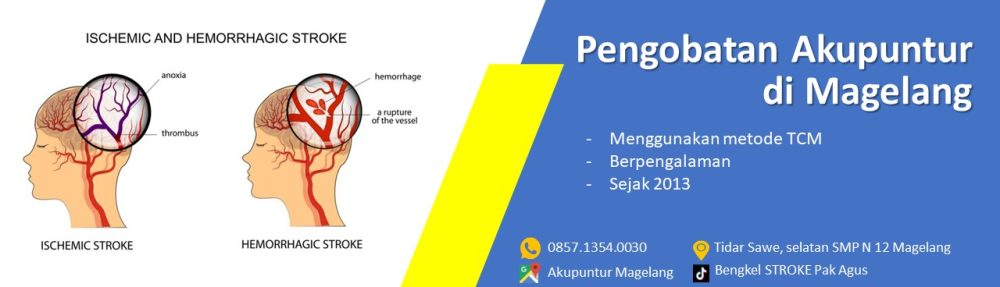 PENGOBATAN STROKE & NYERI PAK AGUS MAGELANG – WA: 0857.1354.0030