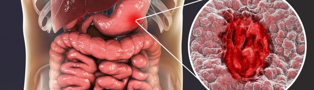 pengobatan kanker lambung dengan akupuntur magelang