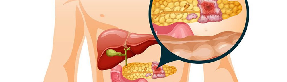 pengobatan kanker pankreas dengan akupuntur magelang