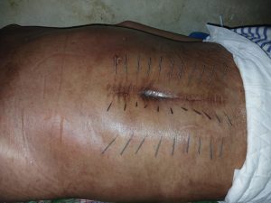 terapi kanker